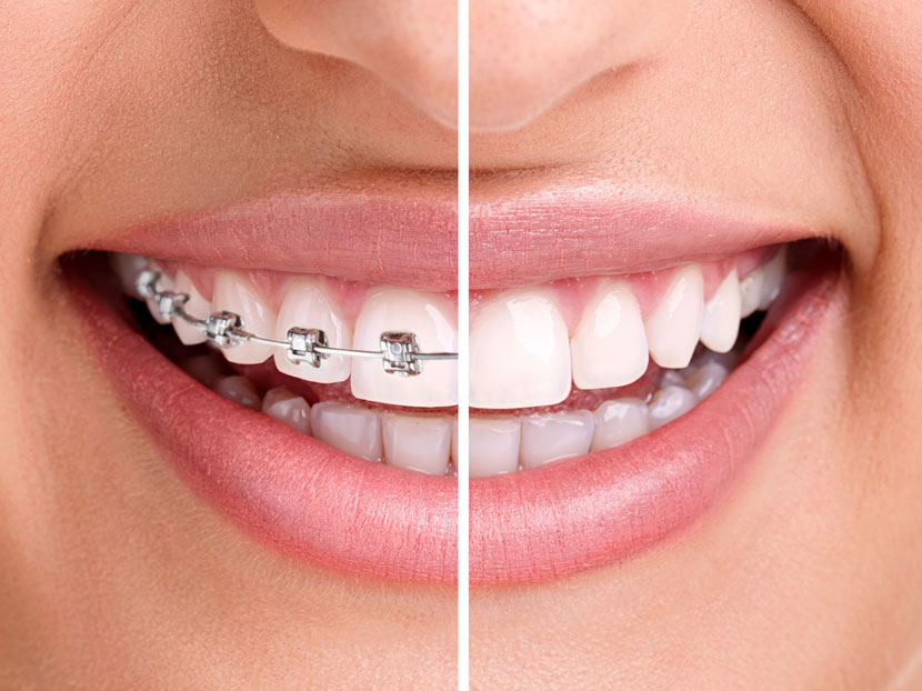 Healthy smile with braces
