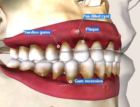 kuch toh Periodontitis