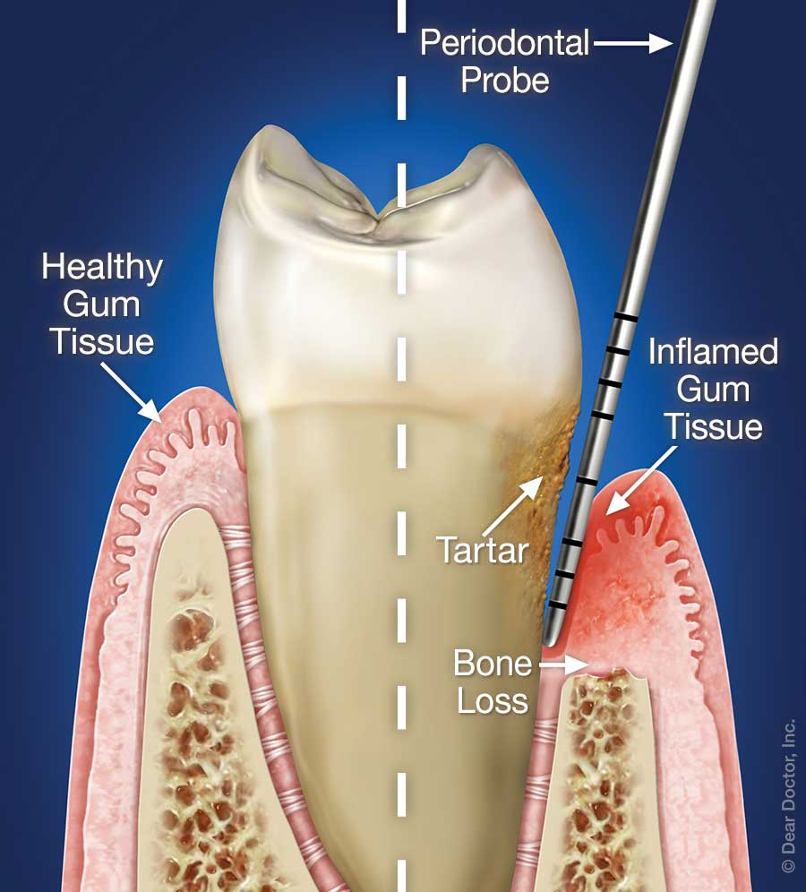 periodontal-disease 1